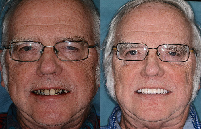 Smileasego™ - Premium Denture