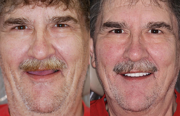 Smileasego™ - Premium Denture