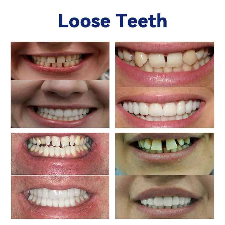 NESLEMYâ˘-Advanced Customized Full Denture Set