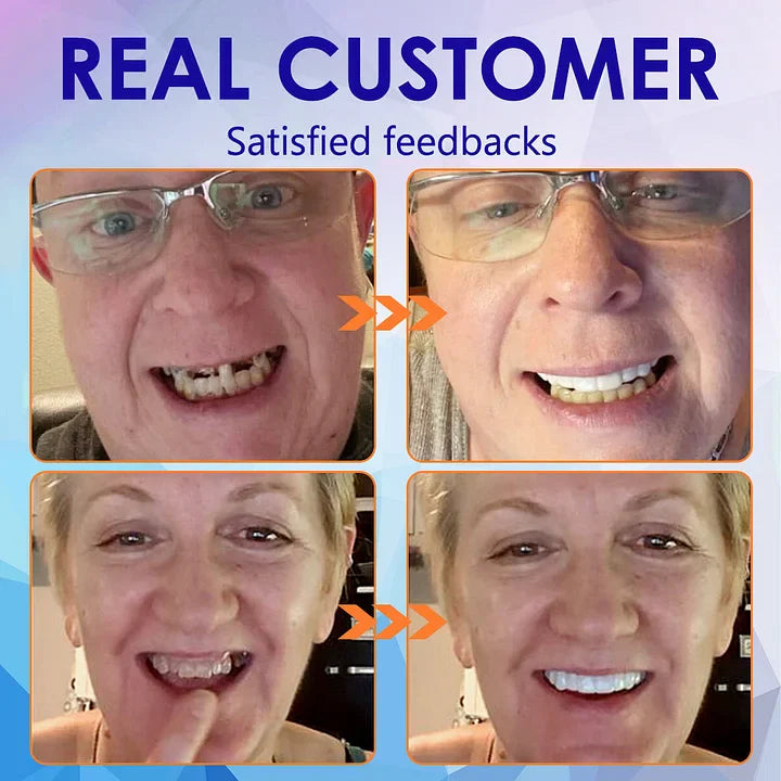 NESLEMYâ˘-Advanced Customized Full Denture Set