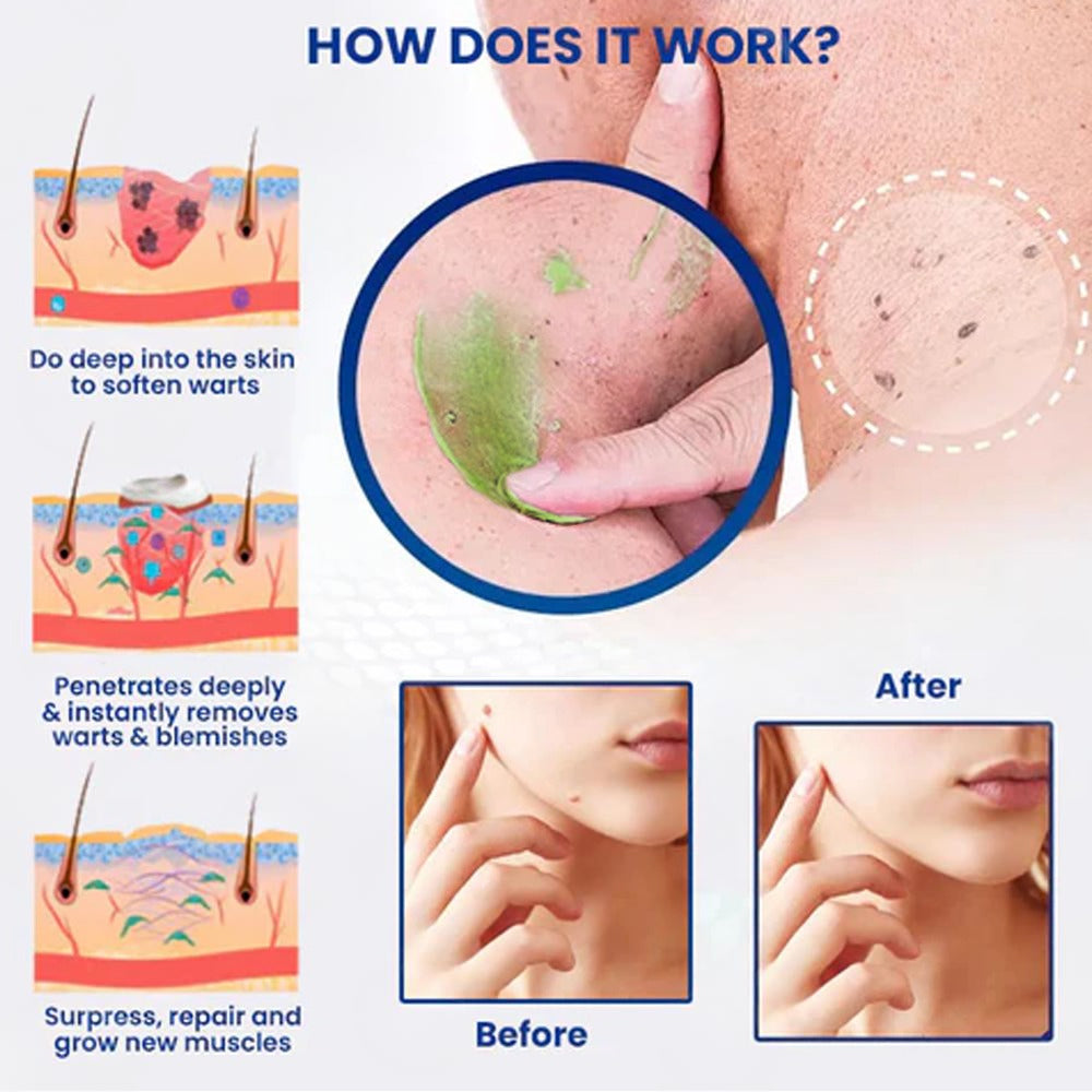 ✅Official Store: LOVILDS™ NatureErase Instant Mole & Spot Cream