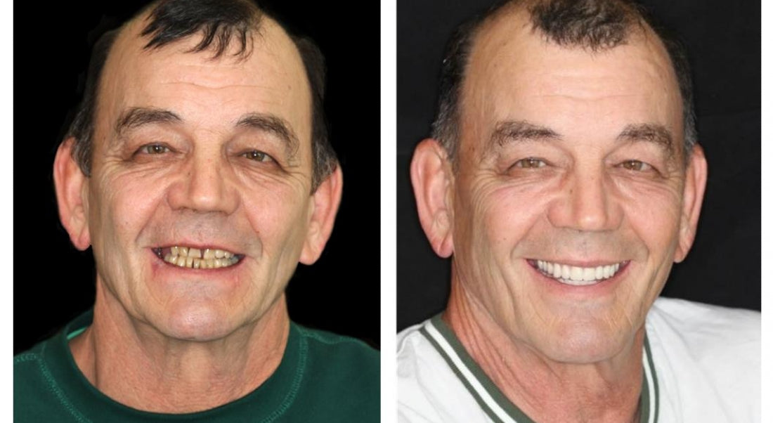 Smileasego™ - Premium Denture