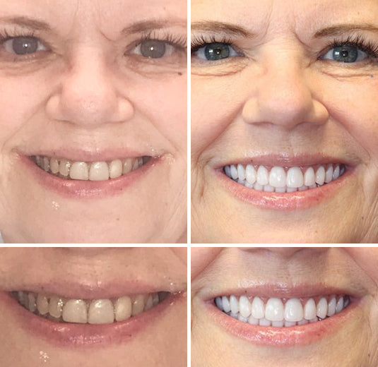 Smileasego™ - Premium Denture