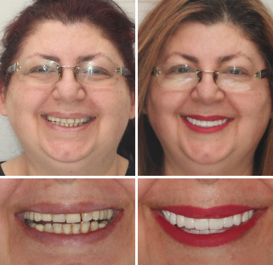 Smileasego™ - Premium Denture