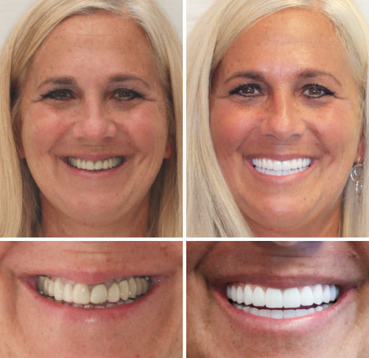 Smileasego™ - Premium Denture