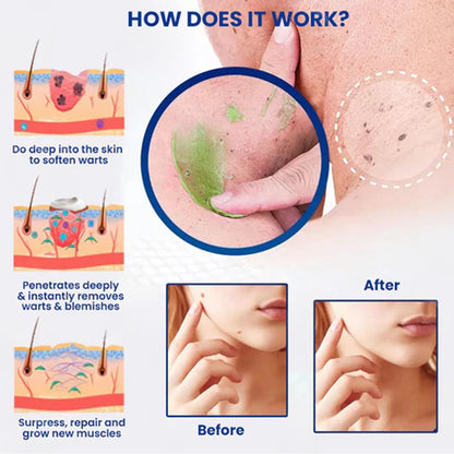 ✅Official Store: LOVILDS™ NatureErase Instant Mole & Spot Cream