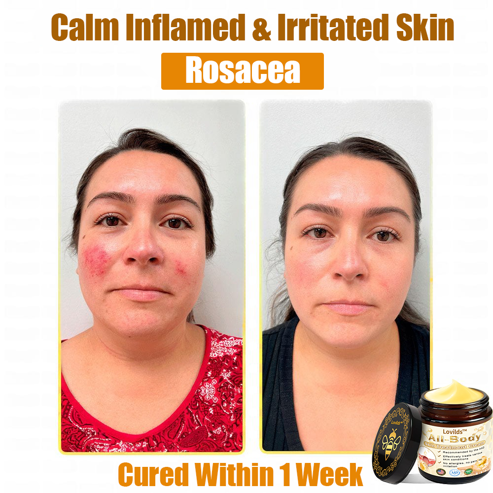LOVILDS™ Bee Venom All-in-One Cream US Dermatologist Approved